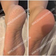 Moroccan Foot Scrubber with Thread - The Ultimate Solution for Cracked Heels